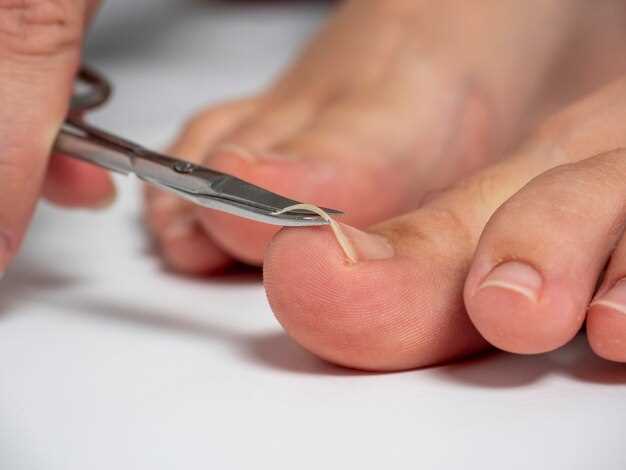 Лечение воспаленного вросшего ногтя: домашние методы и медицинская помощь